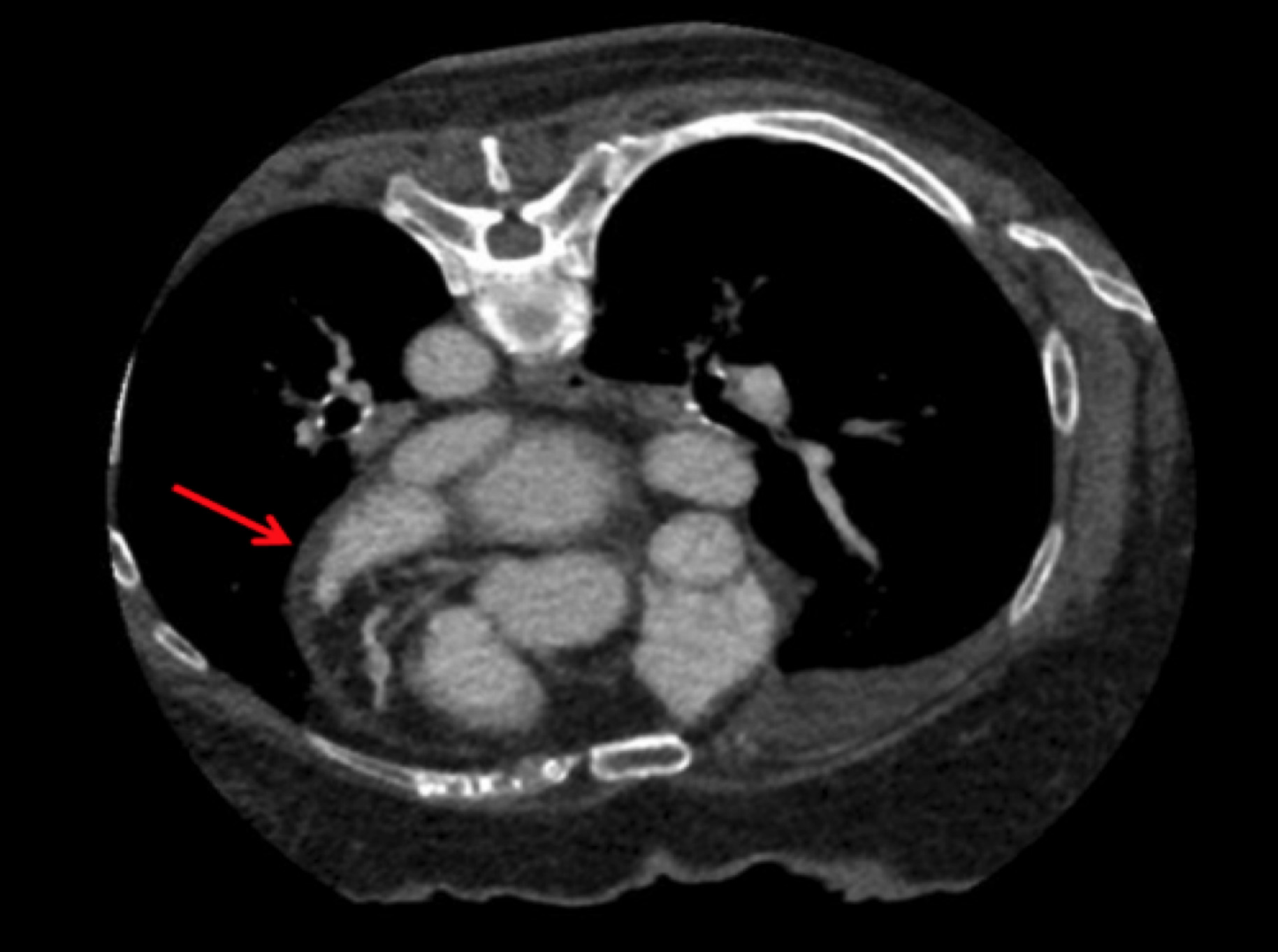 腹臥位での心臓造影CT検査の画像