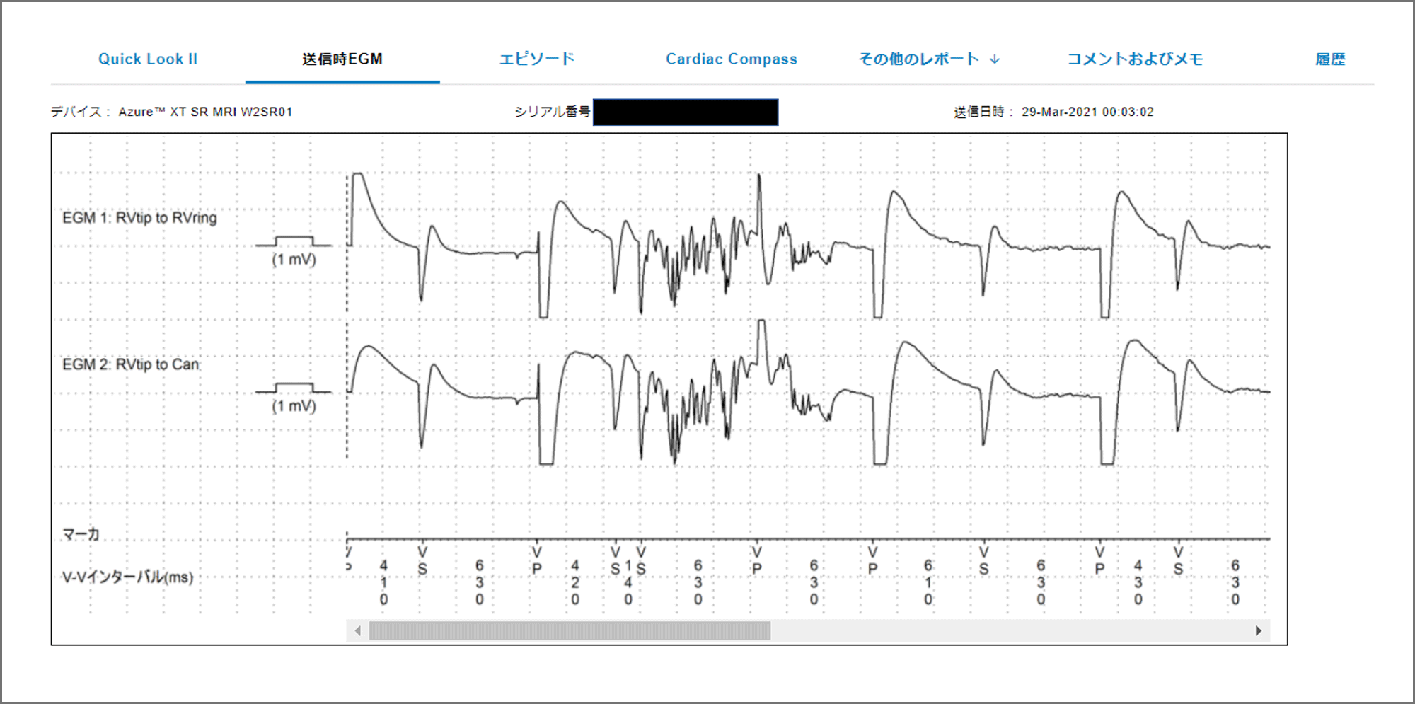 図3：遠隔アラートで受信した, リード断線したペースメーカ症例