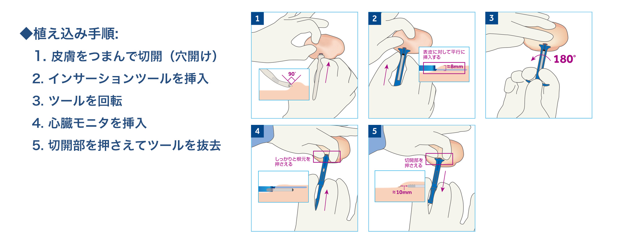 図2：植え込み手技の実際：手順