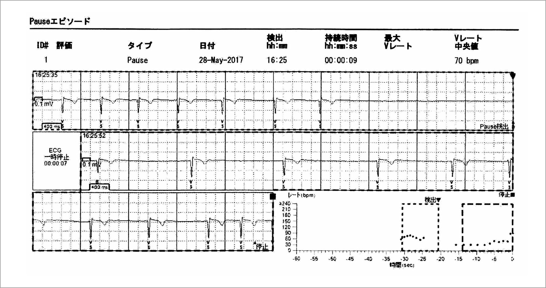 図9 心電図記録計による植え込み2日後のデータ